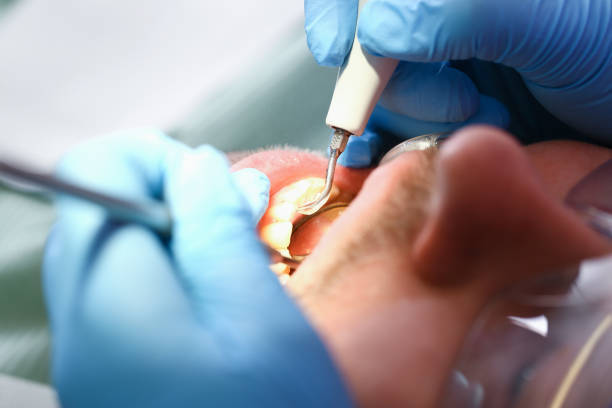 Best Broken or Chipped Tooth Repair in North Redington Beach, FL